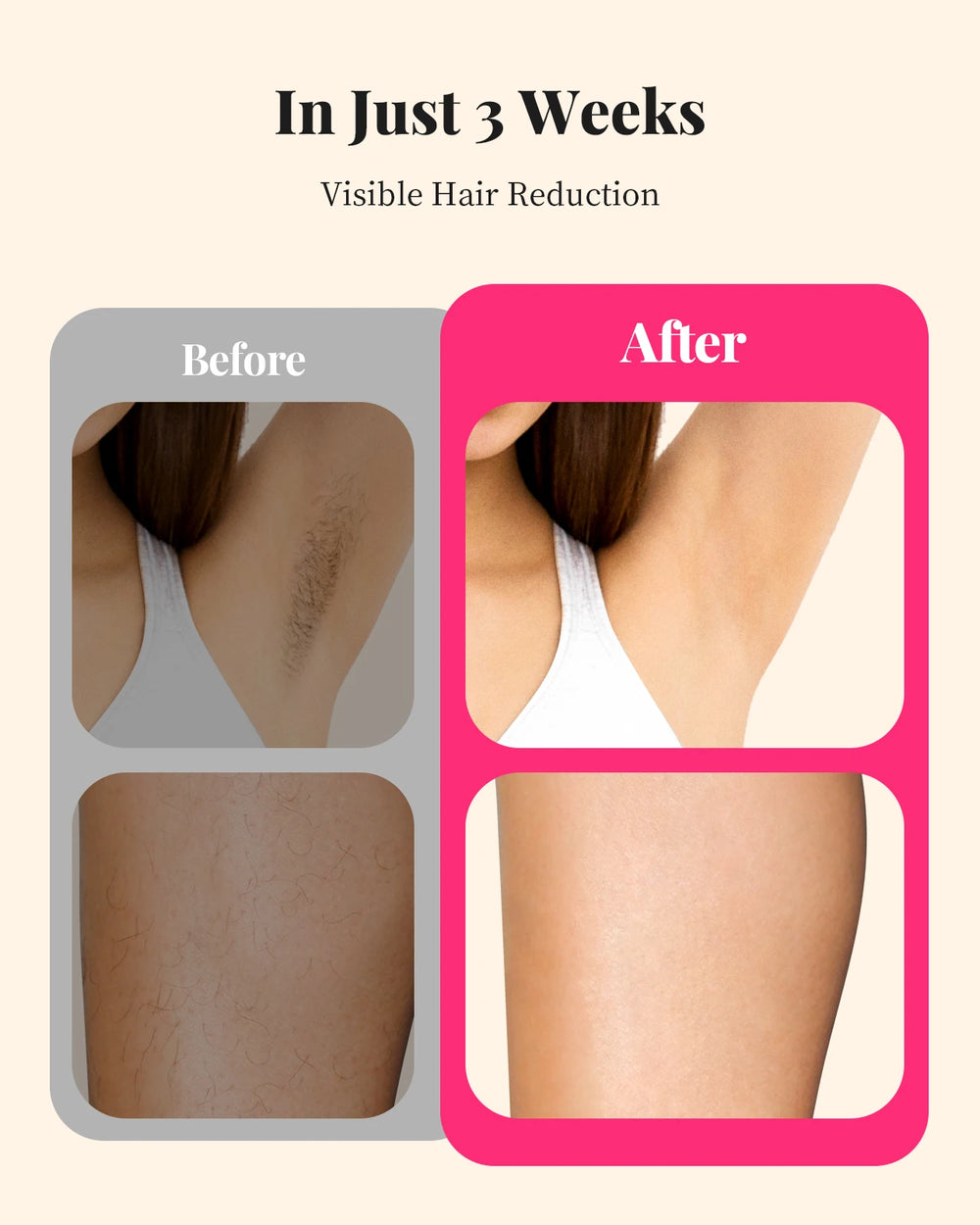 990000 Flashes Hair Removal for Women and Men IPL Hair Removal Body Bikini and Facial Areas Painless Permanent HairRemoval - QueensalesOF